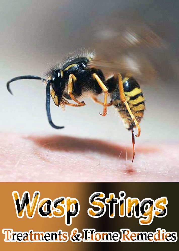 Wasp Stings: Treatments & Home Remedies