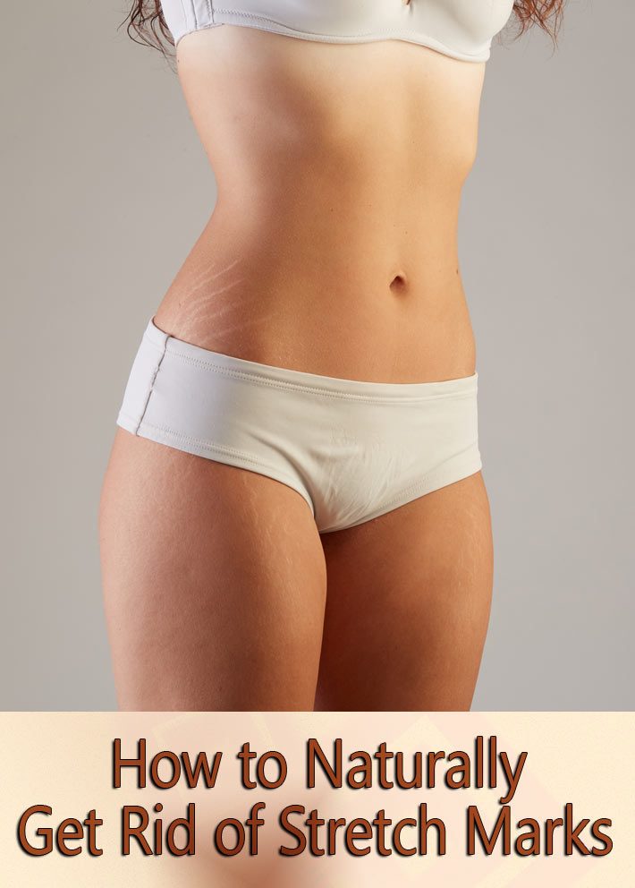 How To Naturally Get Rid Of Stretch Marks