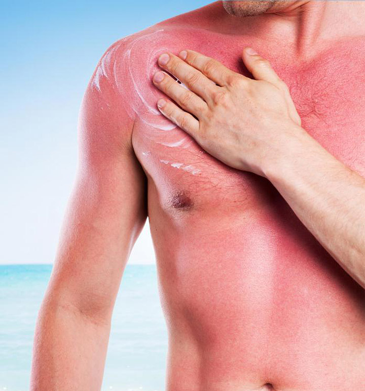 10 Naturally Soothing Sunburn Treatments