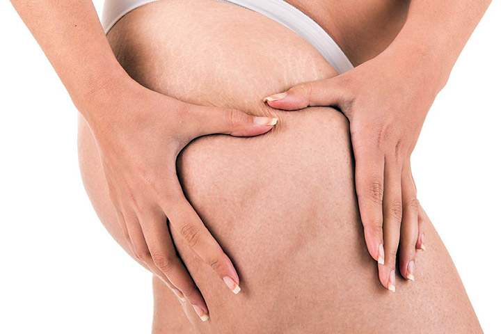Thinking About Liposuction? Read This First!