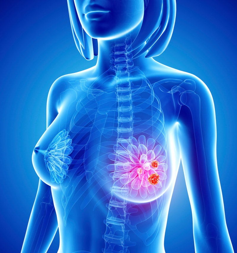 Is The Breast Pain Symptom of Breast Cancer?