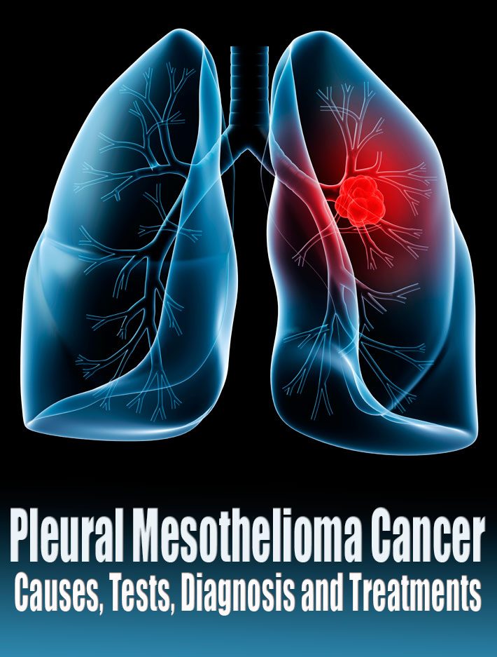 Pleural Mesothelioma Cancer – Causes, Tests, Diagnosis and Treatments